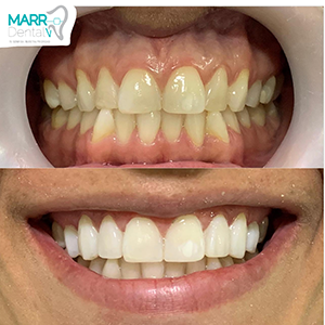 Blanqueamiento dental antes y después