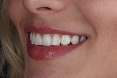 Blanqueamiento dental