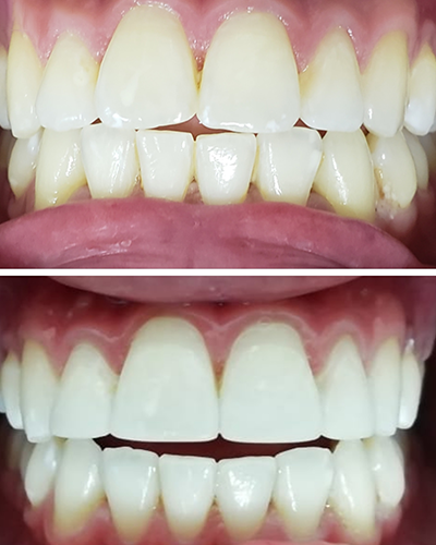 blanqueamiento-marr-dental-medellin Aclaramiento dental