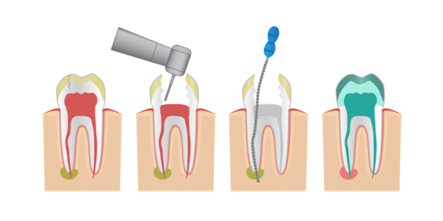 endodoncia-marr-dental-2