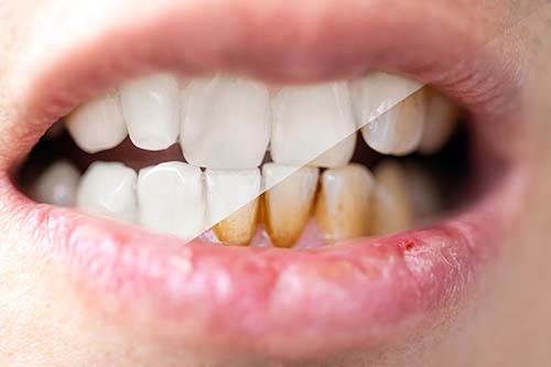 Dientes antes y después de tratamiento de tinciones dentales