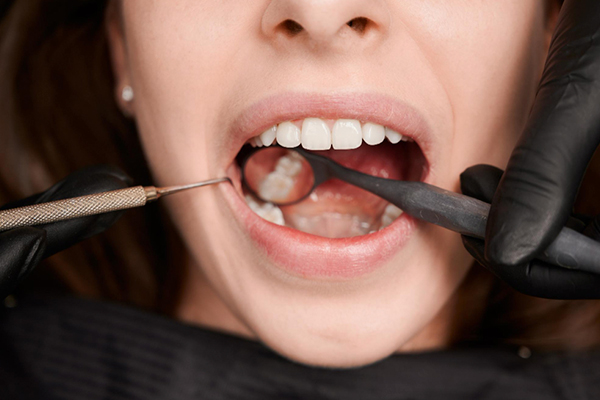 La exodoncia de cordales es una de las cirugías orales más realizadas al año, que requiere cuidados postoperatorios específicos para asegurar una correcta recuperación. El fin de este...