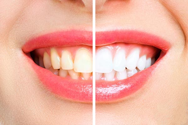 Si deseas mejorar el color de los dientes con eficacia, estás en el lugar adecuado. En este artículo, te proporcionamos consejos generales sobre cómo mejorar el color de los dientes...