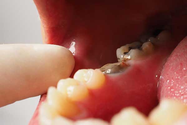 Resinas y amalgamas dentales