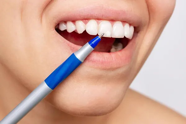 La fluorosis dental es una alteración que ocurre durante la formación de los dientes, cuando existe una sobreexposición al flúor, el cual afecta el esmalte dental. Esto puede causar...