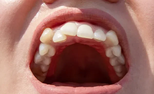 Img-los-mejores-metodos-para-arreglar-dientes-torcidos