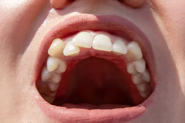 Img-los-mejores-metodos-para-arreglar-dientes-torcidos