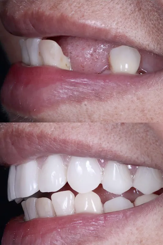 Img-MarrDental-Servicio-Rehabilitación_Oral Img-MarrDental-Servicio-Rehabilitación_Oral