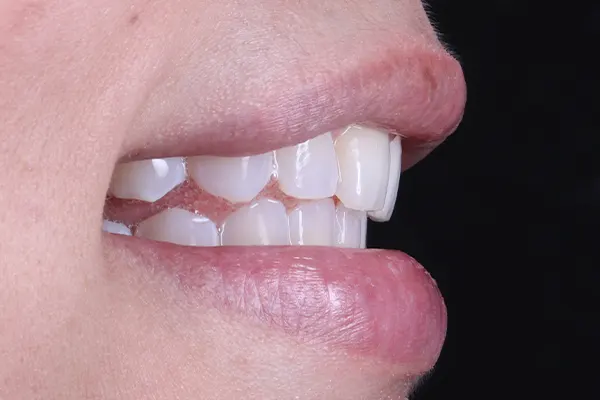 Img-MarrDental-Servicio-blanqueamiento_dental_Medellín-1 Img-MarrDental-Servicio-blanqueamiento_dental_Medellín-1