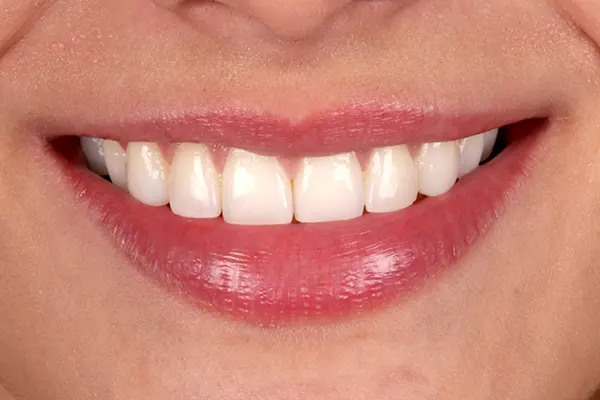 Img-MarrDental-Servicio-blanqueamiento_dental_Medellín-2 Img-MarrDental-Servicio-blanqueamiento_dental_Medellín-2