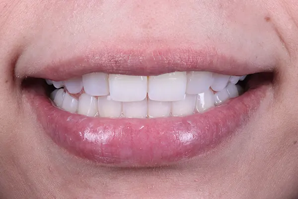 Img-MarrDental-Servicio-blanqueamiento_dental_Medellín-3 Img-MarrDental-Servicio-blanqueamiento_dental_Medellín-3