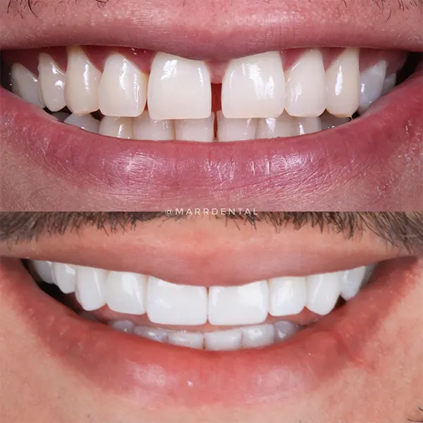 Img-MarrDental-Servicio-diseno-de-sonrisa-medellin-1 Img-MarrDental-Servicio-diseno-de-sonrisa-medellin-1