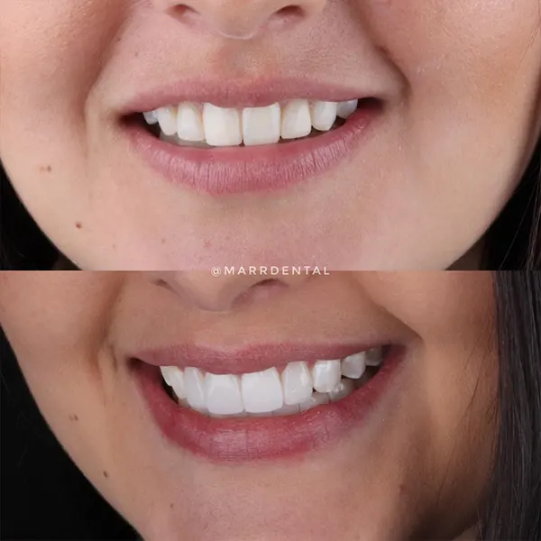 Img-MarrDental-Servicio-diseno-de-sonrisa-medellin-2 Img-MarrDental-Servicio-diseno-de-sonrisa-medellin-2