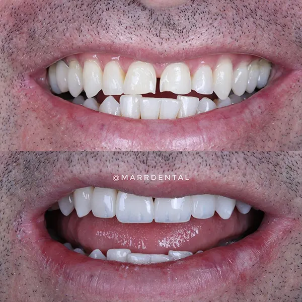 Img-MarrDental-Servicio-diseno-de-sonrisa-medellin-3 Img-MarrDental-Servicio-diseno-de-sonrisa-medellin-3