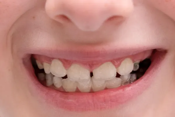 La cirugía para frenillo labial es un procedimiento sencillo que puede transformar tu comodidad al hablar, sonreír y comer. Si has notado tensión en el labio superior o problemas al...