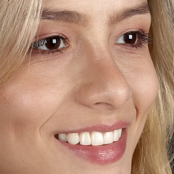 Img-Marr_Dental-Card-Servicio-Blanqueamiento_dental