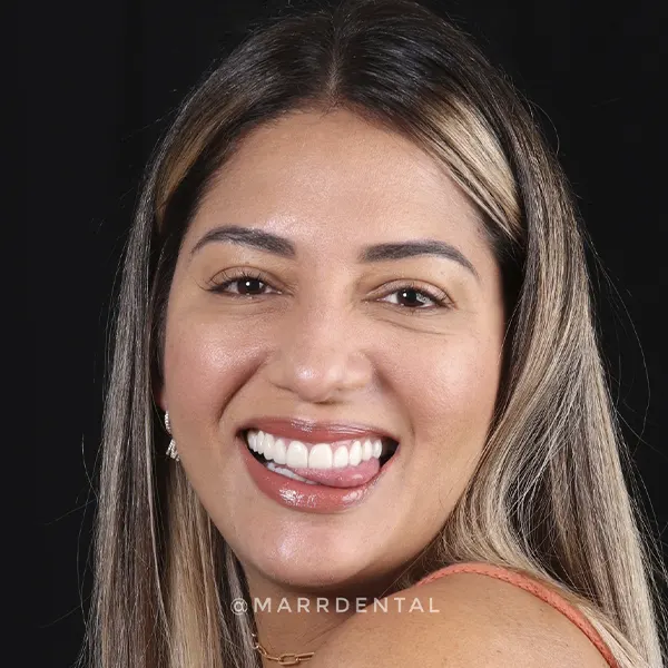 Img-Marr_Dental-Card-Servicio-Diseño_de_sonrisa