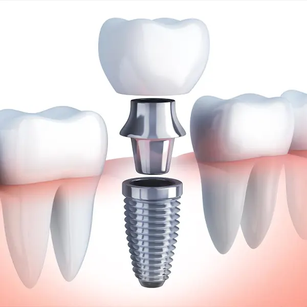 Img-Marr_Dental-Card-Servicio-Implantes_Dentales