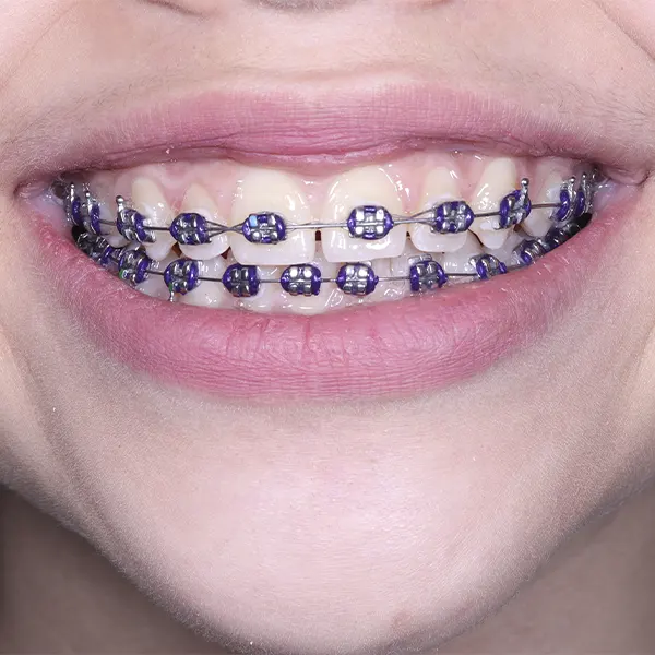 Img-Marr_Dental-Card-Servicio-Ortodoncia