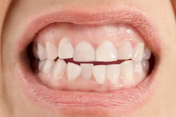 Sentir inseguridad por tener los dientes torcidos es común, pero el deseo de una sonrisa hermosa siempre está presente. Muchas personas se preguntan si se puede hacer diseño de sonrisa...