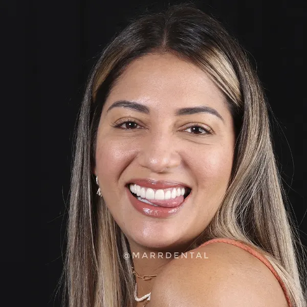 img-diseno-de-sonrisa-en-envigado-1