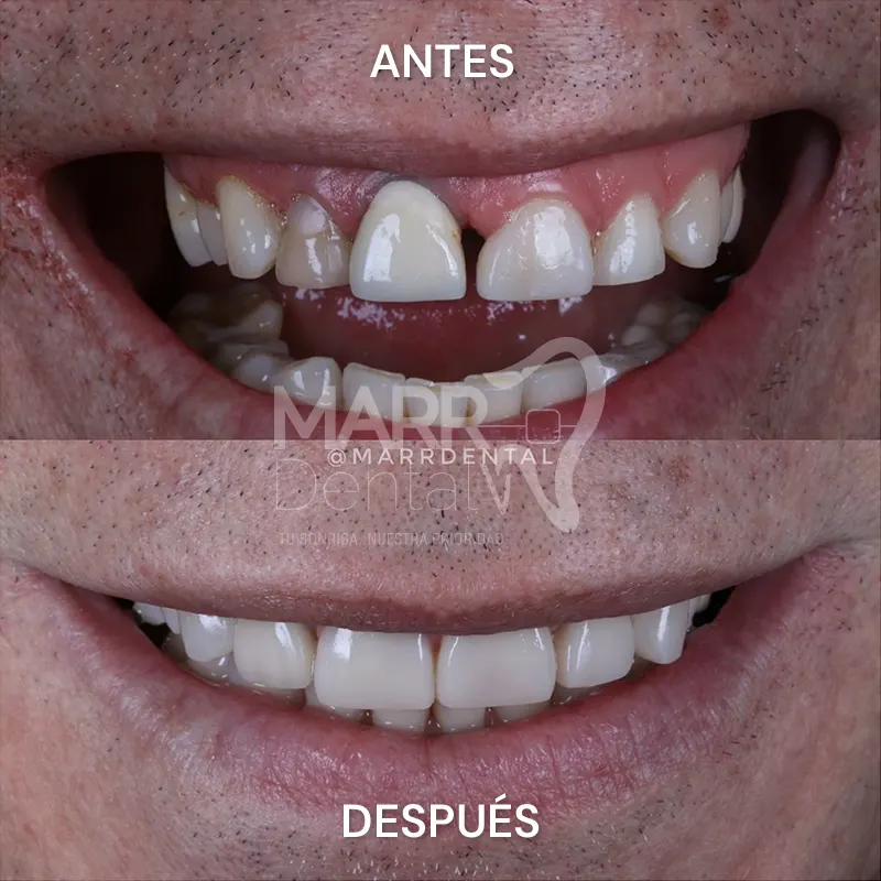 Diseño_de_sonrisa-1