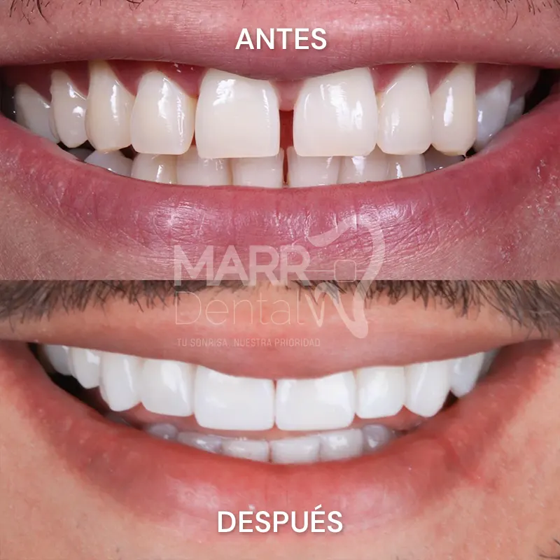 Diseño_de_sonrisa-3